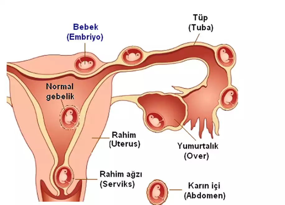 9 Soruda Dış Gebelikle İlgili Tüm Bilinmeyenler