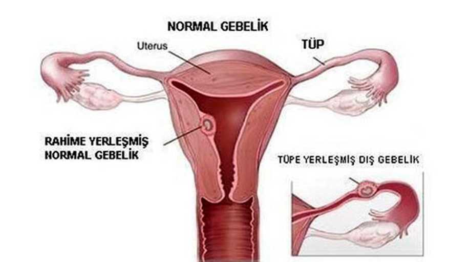 9 Soruda Dış Gebelikle İlgili Tüm Bilinmeyenler