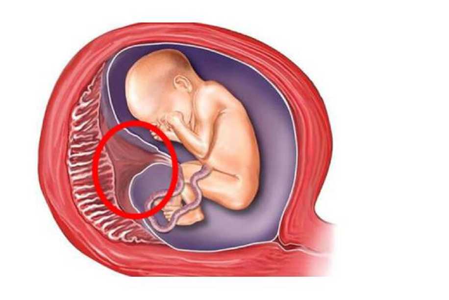Plasenta Yaşlanması (Kireçlenmesi) Nedir?