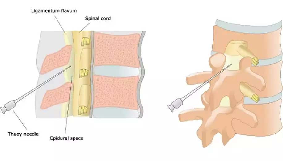 Ağrısız Doğum (Epidural) Yöntemi Nasıl Uygulanıyor?