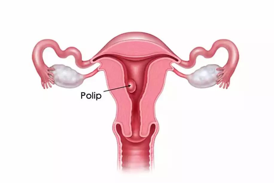 Polip Nedir? Rahimde Polip Belirtileri, Tedavisi ve Polip Ameliyatı