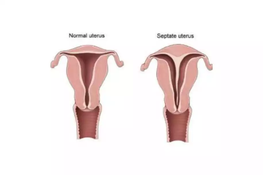 Rahimde Perde Olması (Septum Uterus) Gebeliğe Engel midir?