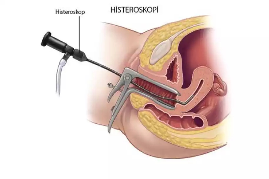 Rahimde Perde Olması (Septum Uterus) Gebeliğe Engel midir?