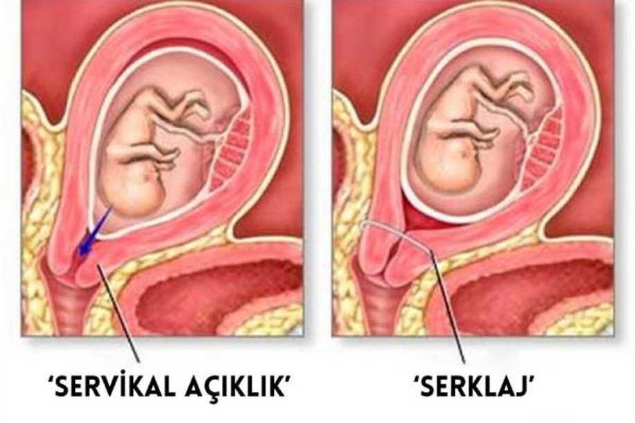 Rahim Ağzı Dikişi (Serklaj) Nedir, Neden Yapılır?