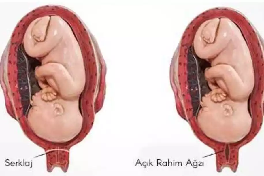 Rahim Ağzı Dikişi (Serklaj) Nedir, Neden Yapılır?