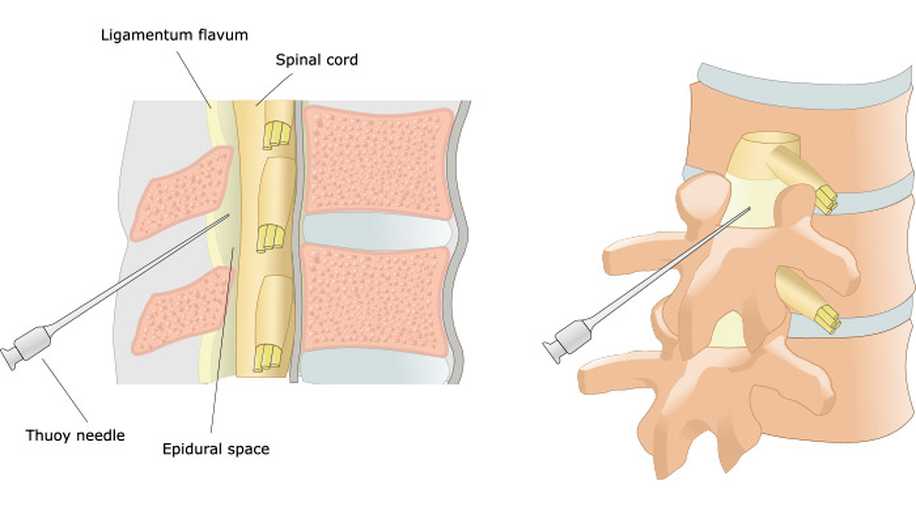 Epidural Anestezi İle Ağrısız Normal Doğum ve Yan Etkileri