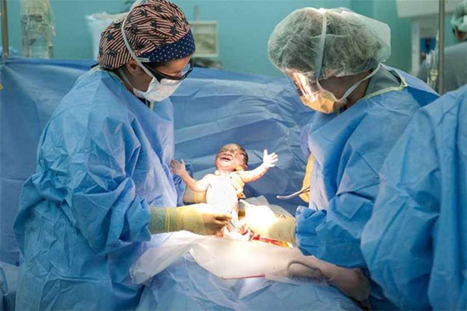 10 Soruda Sezaryen Doğum