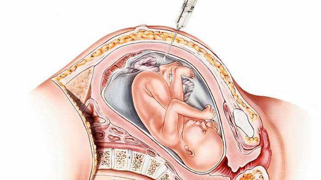 Amniyosentez Nedir?