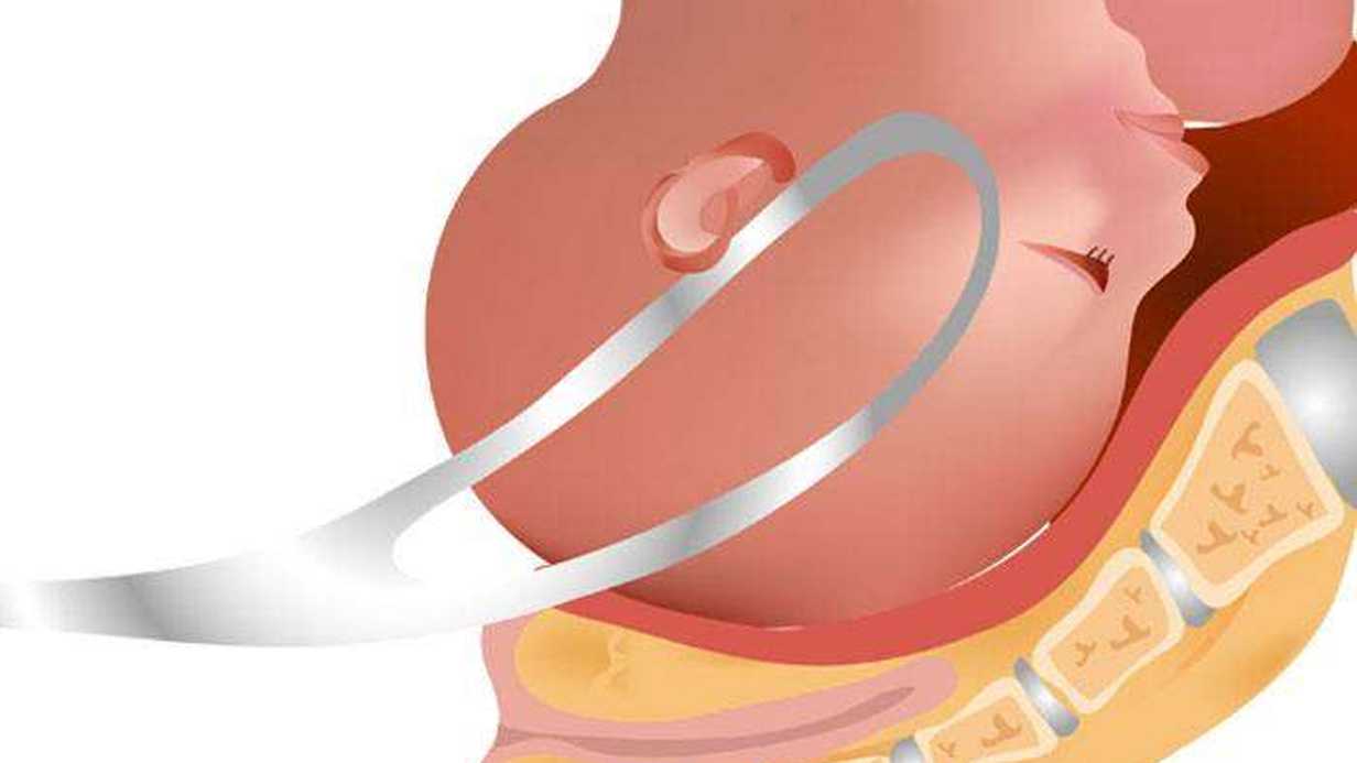 Forseps Nedir?
