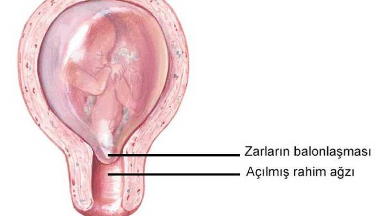 Rahim Ağzı Dikişi (Serklaj) Nedir, Neden Yapılır?