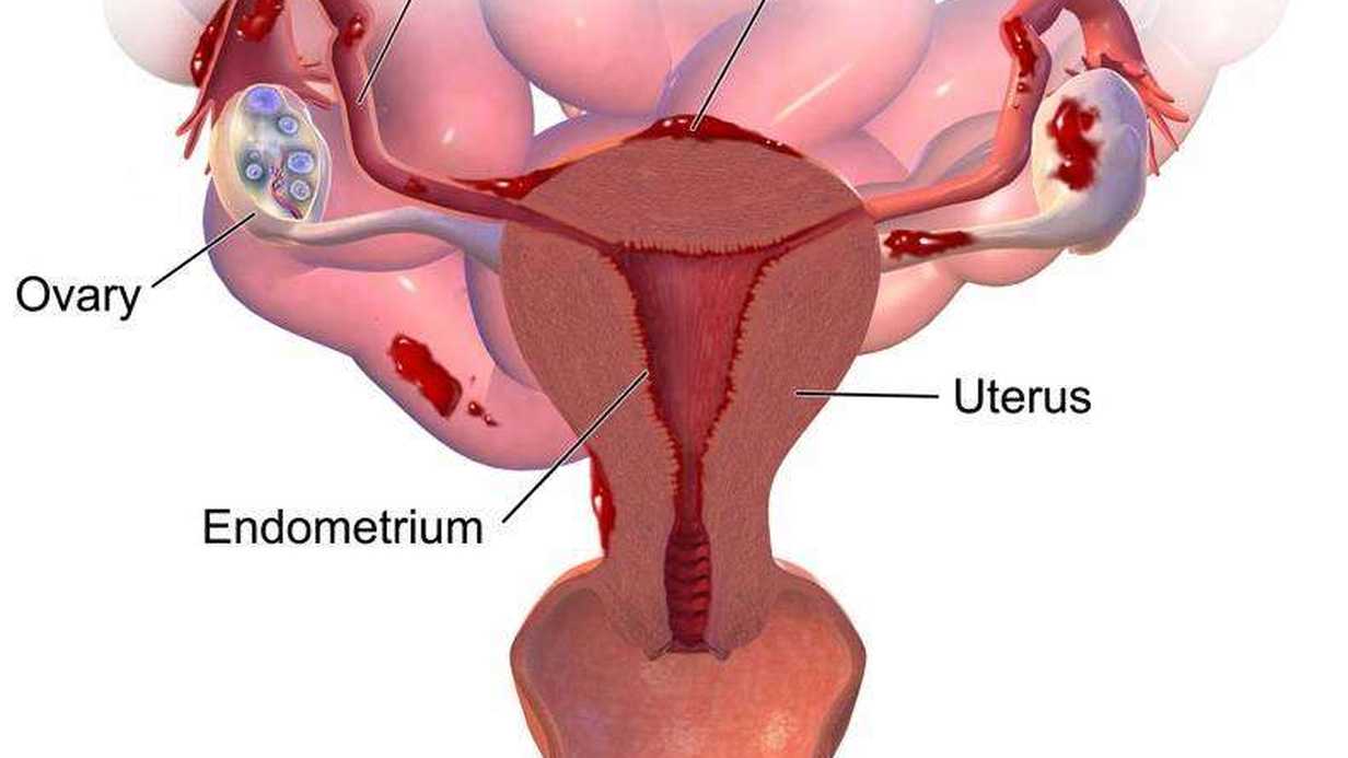 Yumurtalık Büyümesi Nedenleri Nelerdir?