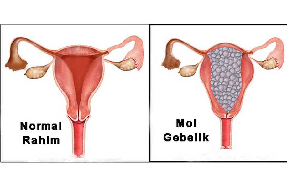 Mol Gebelik Sonrası Hamilelik İçin Ne Kadar Beklenmeli?