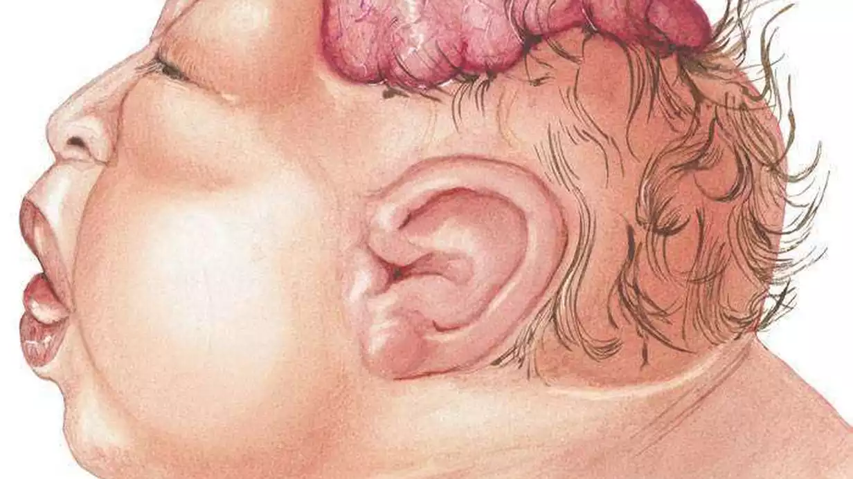 Anensefali Nedir?