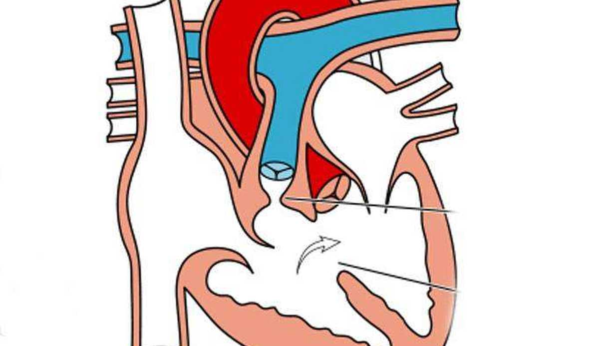 Fallot Tetralojisi Nedir?
