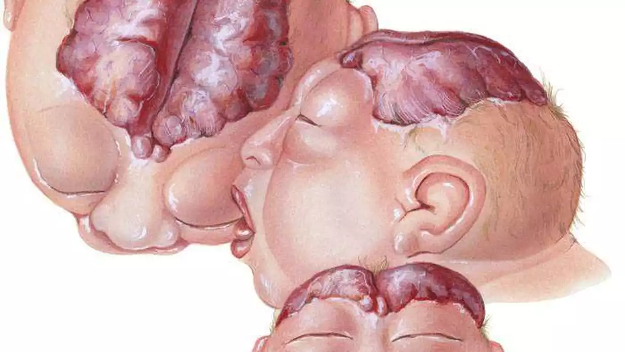 Nöral Tüp Defekti (Kusuru) Nedir?