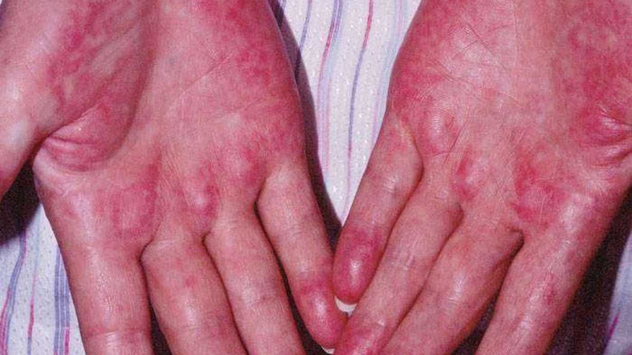 Palmar Eritem Nedir?