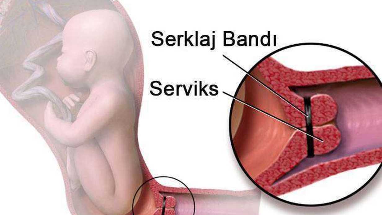 Servikal Serklaj Yöntemi Nedir?