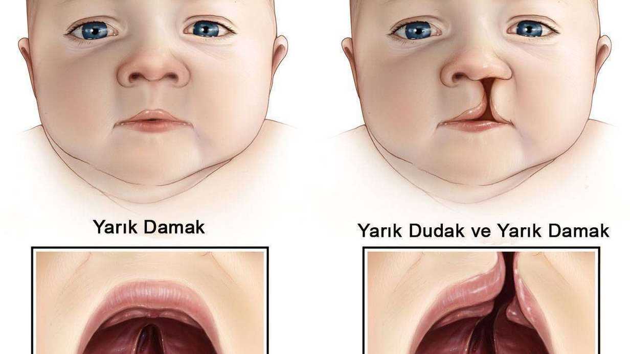Yarık Dudak ve Damak Deformasyonu Nedir?