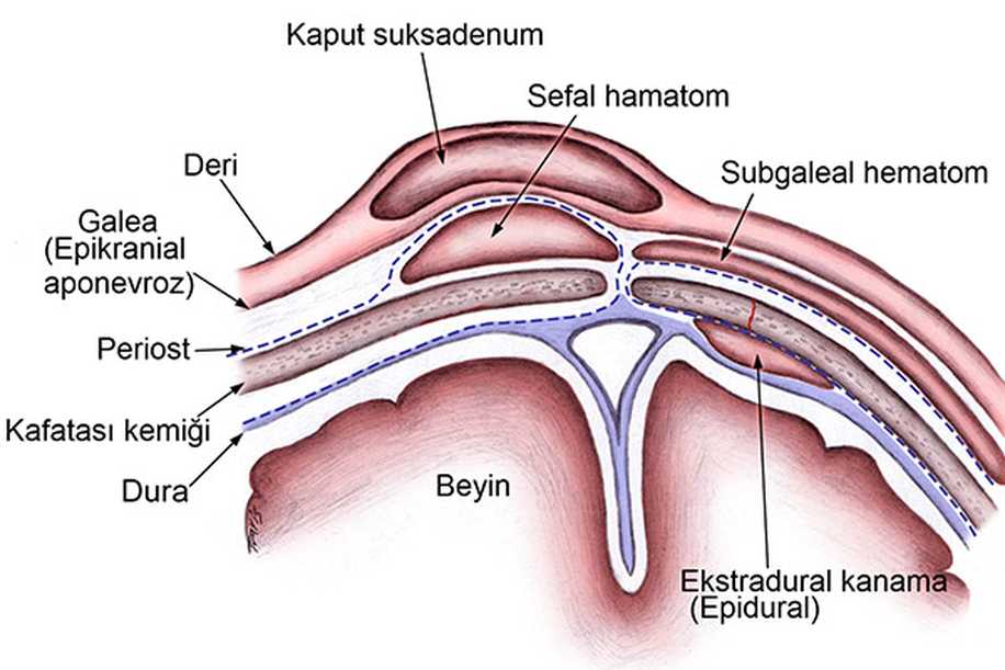 Doğumdan Sonra Bebeğin Kafasındaki Şekil Bozukluğu & Şişlik