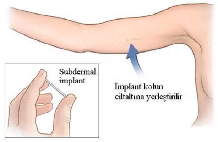 Deri Altı İmplantları ile Gebelikten Korunma